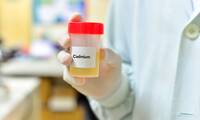 Cadmium Le dépistage bientôt remboursé, mais pas pour tous