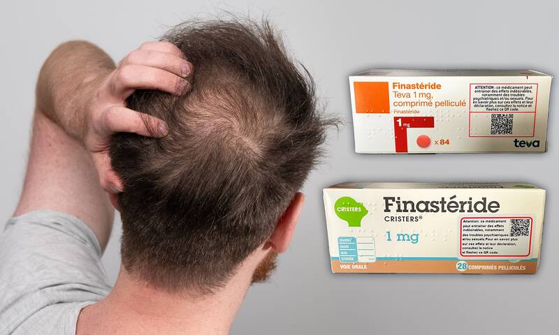 Calvitie Le finastéride officiellement lié à un risque suicidaire Calvitie Le finastéride officiellement lié à un risque suicidaire