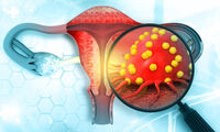 Cancer de l’endomètre Courant mais méconnu