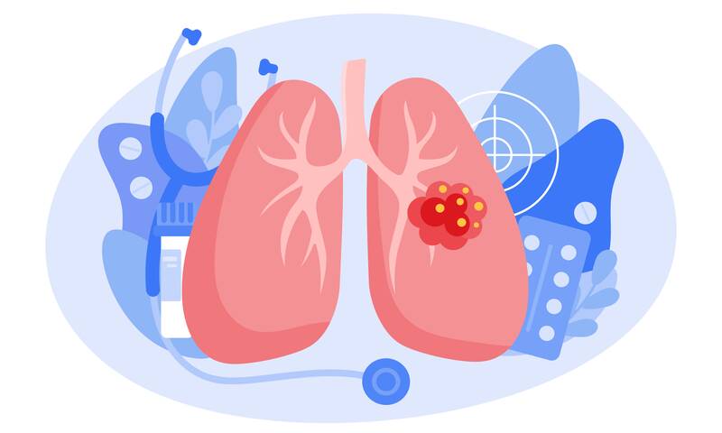 Dépistage du cancer du poumon - Une expérimentation avant un éventuel dépistage organisé