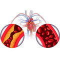 Hypertension •
Certains médicaments peuvent faire monter la pression