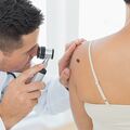 L’hydrochlorothiazide associé à un risque de cancer de la peau