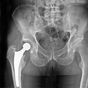 Prothèses de hanche - Les plus récentes ne sont pas forcément les meilleures
