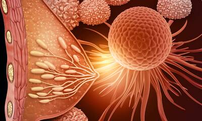 Cancer du sein Les effets secondaires des hormonothérapies difficiles à vivre