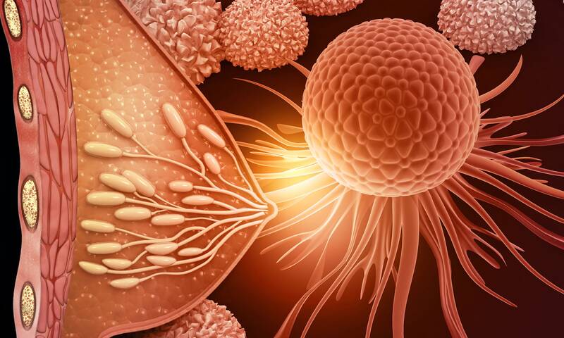 Cancer du sein Les effets secondaires des hormonothérapies difficiles à vivre