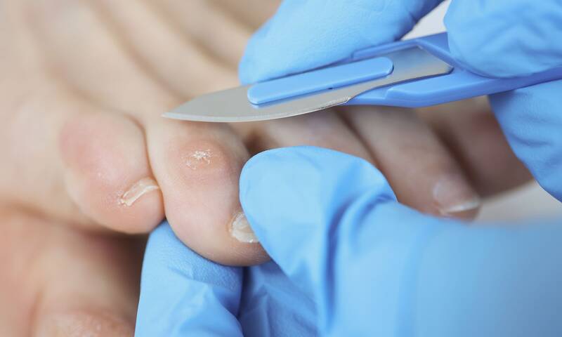 Cors, durillons et ongles incarnés Petits maux, grandes conséquences Cors, durillons et ongles incarnés Petits maux, grandes conséquences
