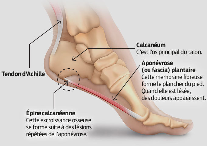 infographie talon