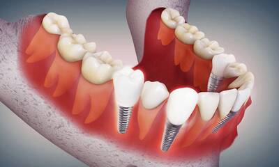 Implants dentaires Des complications méconnues