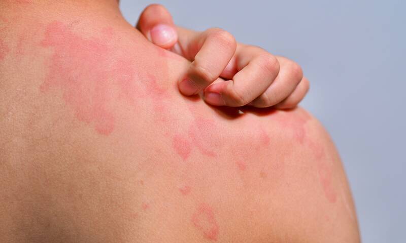 Les allergies méconnues aux produits de soins
