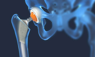 Opération Les complications après la pose d'une prothèse de hanche
