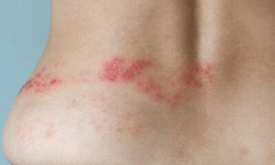 Zona Des douleurs parfois très tenaces