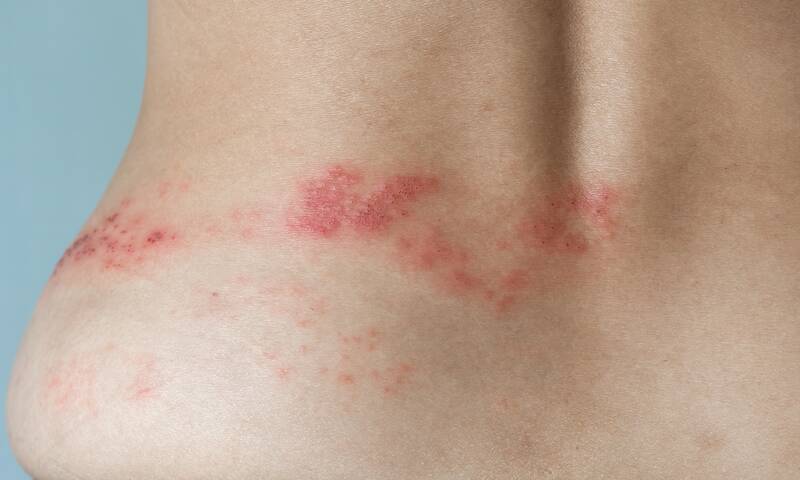 Zona Des douleurs parfois très tenaces