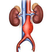 Anévrisme de l’aorte abdominale Un dépistage méconnu et débattu