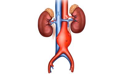 Anévrisme de l’aorte abdominale Un dépistage méconnu et débattu