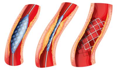 Artères bouchées Pose-t-on trop de stents ?