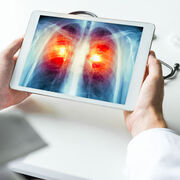 Cancer du poumon Un dépistage qui fait débat
