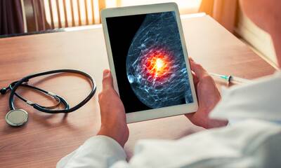 Cancer du sein Les effets indésirables des anti-aromatase enfin reconnus