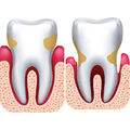 Gingivite et parodontite •
Que valent les traitements des gencives ?