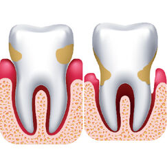 Gingivite et parodontite Que valent les traitements des gencives ?