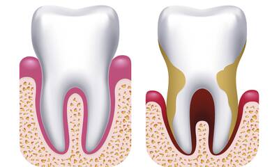 Gingivite et parodontite Que valent les traitements des gencives ?