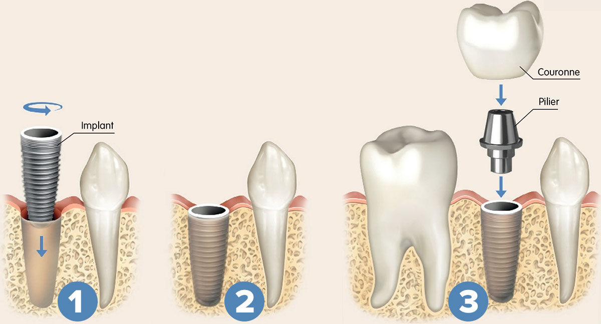 Infographie implants dentaires