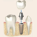 Implants dentaires •
Mode d'emploi