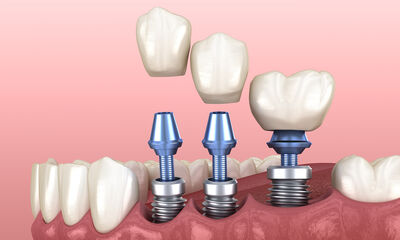Implants dentaires Mode d'emploi