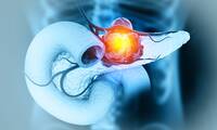 Cancer du pancréas Pourquoi tant de nouveaux cas ?