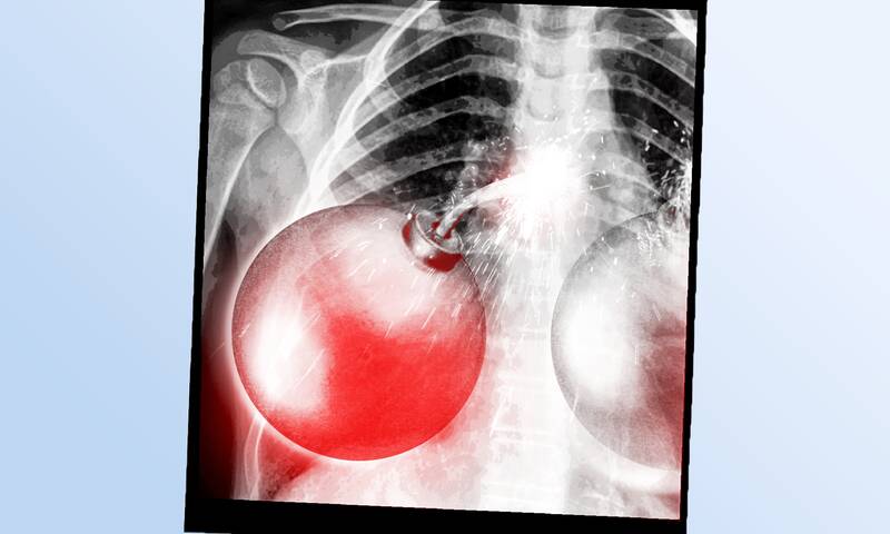 Dispositifs médicaux dangereux Une réglementation bien molle