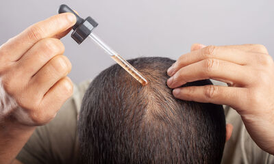 Chute de cheveux Existe-t-il des traitements efficaces ?
